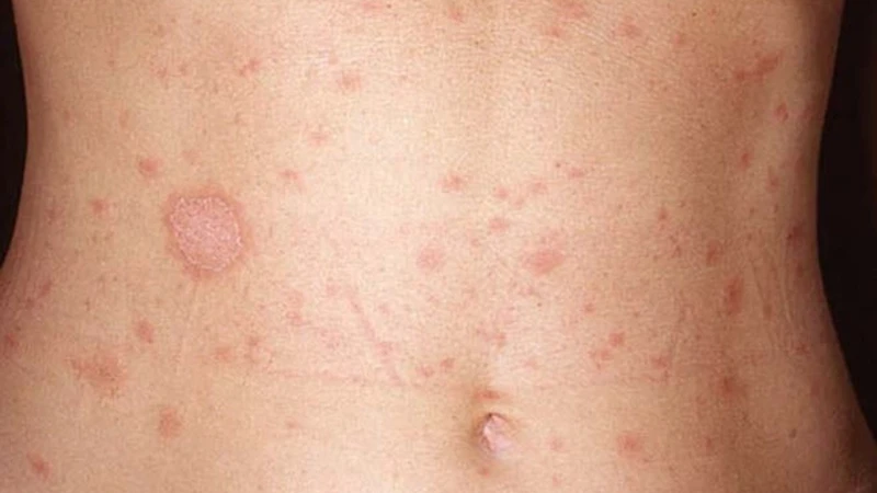 Giang mai giai đoạn 1 có nguy hiểm không? Dấu hiệu nhận biết và phương pháp điều trị 1