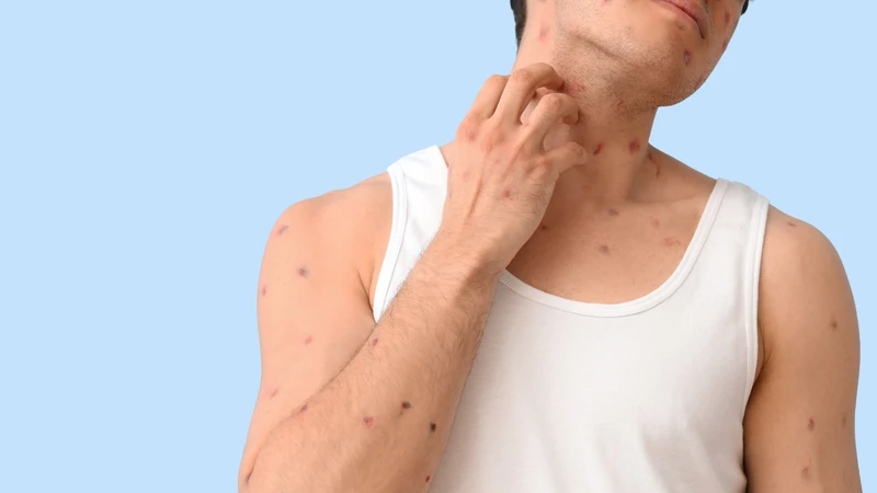 Bệnh chàm: Nguyên nhân, triệu chứng và điều trị 1