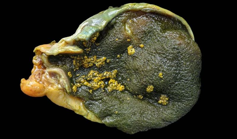 Nhiễm cholesterol thành túi mật là tình trạng cholesterol dư thừa lắng đọng và thấm vào thành túi mật