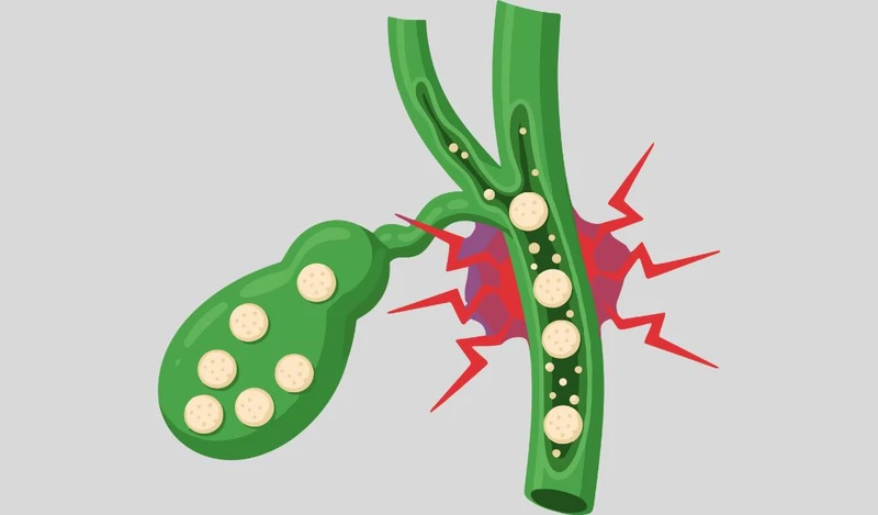 Nhiễm cholesterol túi mật không điều trị có nguy cơ hình thành sỏi mật