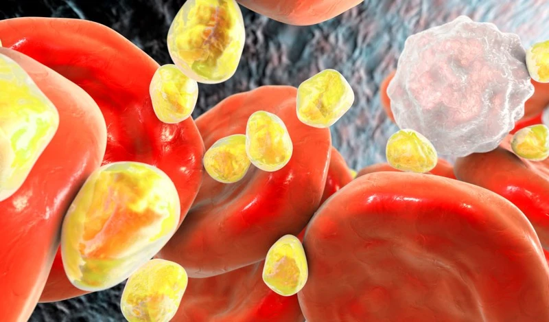 Nhiễm cholesterol túi mật làm tăng nguy cơ hình thành sỏi nếu không điều trị kịp thời