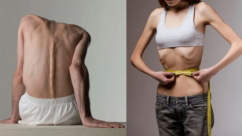 Người bệnh HIV giai đoạn AIDS thường mệt mỏi, suy kiệt và sụt cân nhiều