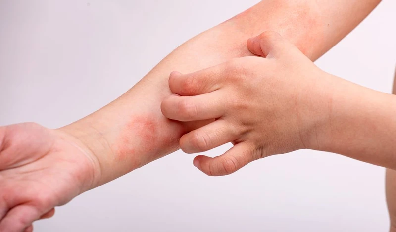 Da đỏ, nổi mụn nước li ti khiến trẻ ngứa và gãi nhiều, dễ để lại sẹo