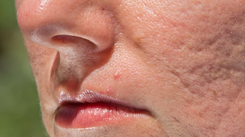 Công nghệ Laser CO2 Fractional giúp điều trị sẹo rỗ và sẹo mụn