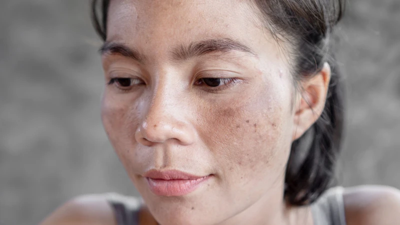 Laser CO2 Fractional&nbsp;hỗ trợ trị nám và tàn nhang hiệu quả