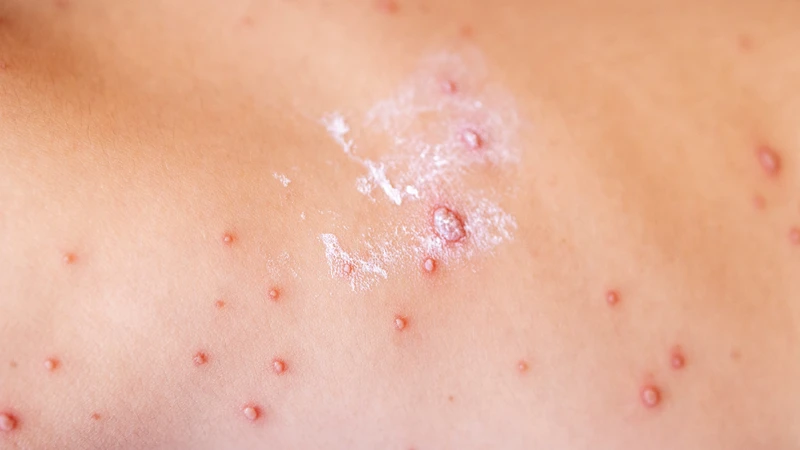 Lứa tuổi nào thường mắc bệnh sởi nhiều nhất và biện pháp phòng tránh hiệu quả