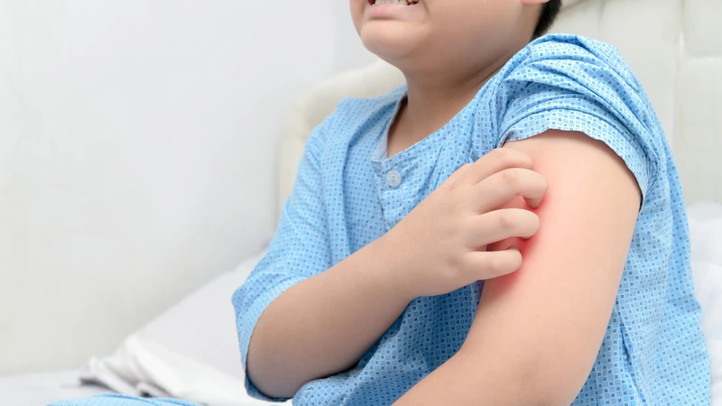 Nổi mề đay ở trẻ em kiêng gì và nên ăn gì để giảm mẩn ngứa 3.png