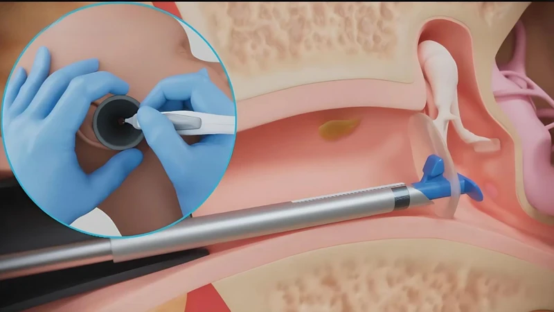 Rối loạn chức năng vòi nhĩ: Nguyên nhân, triệu chứng và điều trị 6