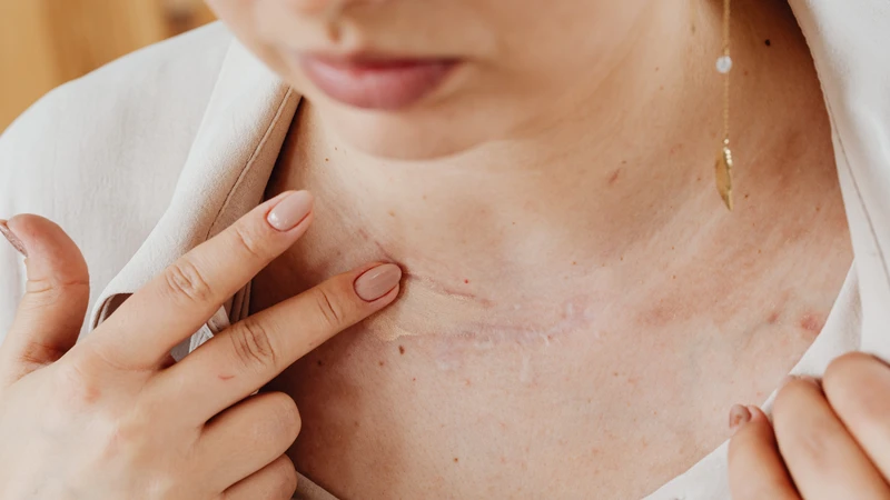Sẹo lõm do thủy đậu có điều trị được không 2.png