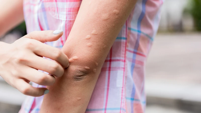 Trẻ bị mẩn ngứa khắp người do đâu Nguyên nhân thường gặp và cách phòng ngừa hiệu quả 2.png