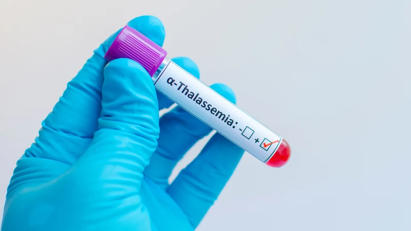 Alpha Thalassemia là một rối loạn huyết học di truyền thuộc nhóm Thalassemia