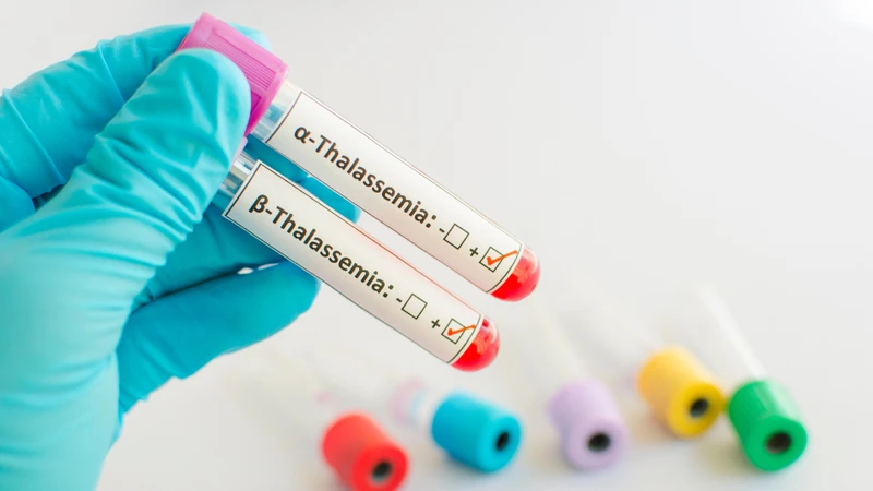 Alpha Thalassemia và Beta Thalassemia đều là các bệnh lý di truyền lặn trên nhiễm sắc thể thường
