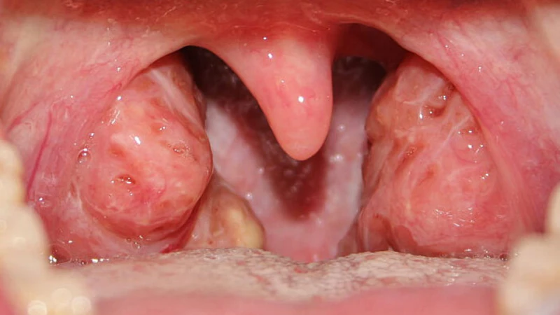 Viêm amidan tái phát nhiều lần có thể là nguyên nhân khiến amidan quá phát độ 3