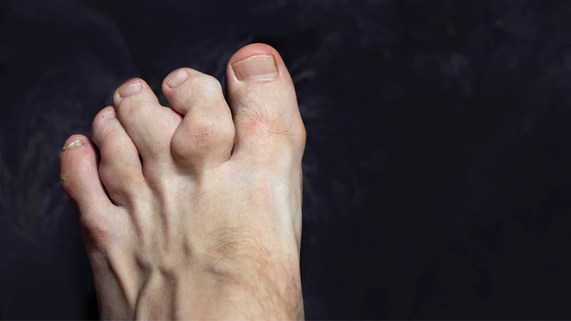 Người bị gout nên hỏi bác sĩ trước khi ăn lại hải sản thường xuyên