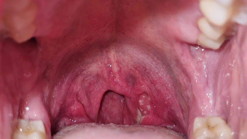 Áp xe amidan là tình trạng hình thành một ổ mủ khu trú ở vùng quanh amidan