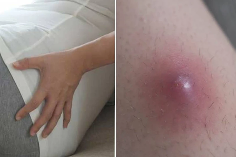Áp xe mông là gì? Nguyên nhân, triệu chứng và hướng điều trị 2