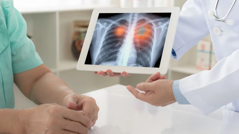 Áp xe phổi có nguy hiểm không​? Cách điều trị 4