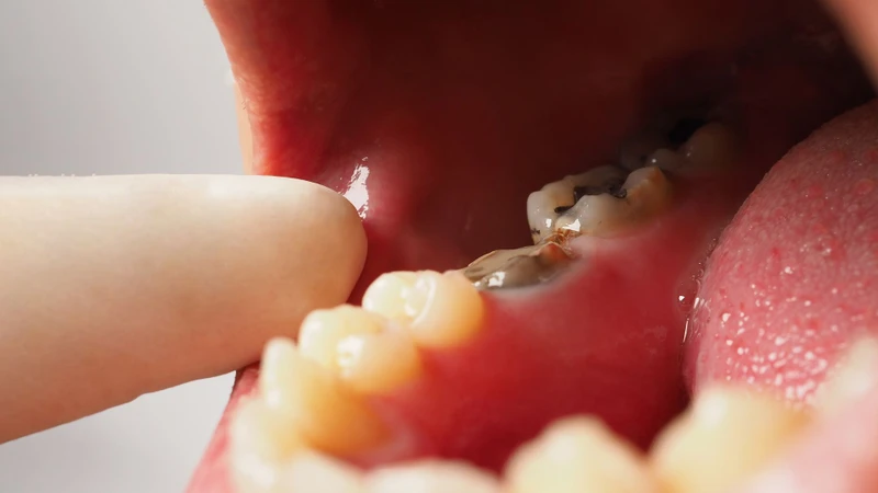 Áp xe răng là gì và có nguy hiểm không? 3