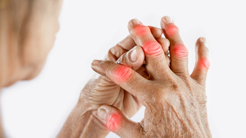 Axit uric cao gây nên các cơn gout cấp, đau đớn và ảnh hưởng nghiêm trọng đến sinh hoạt hàng ngày