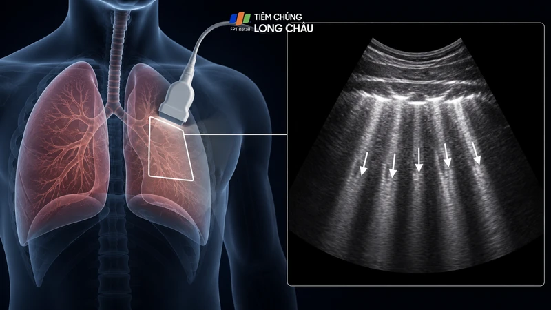 Siêu âm phổi là kỹ thuật nhanh chóng, an toàn để đánh giá tình trạng ứ dịch tại phổi
