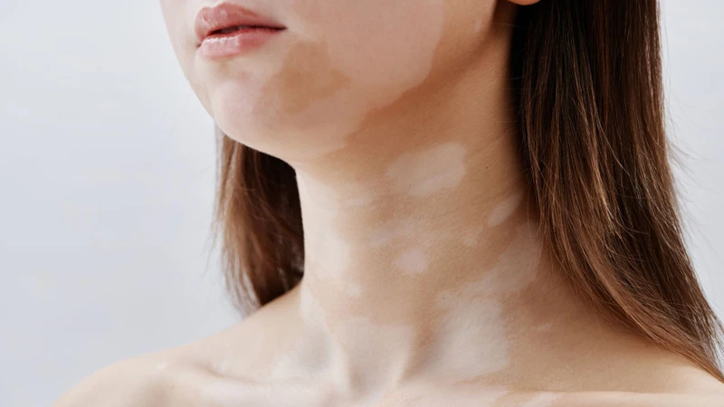 Xuất hiện các đốm trắng hoặc mảng sắc tố là biểu hiện đặc trưng của bạch biến