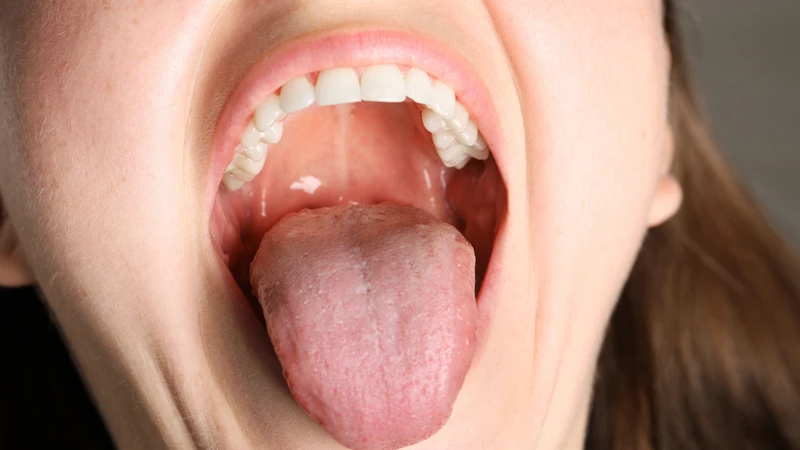Bạch sản lông: Triệu chứng cảnh báo vấn đề về miễn dịch 2