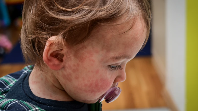 ban-soi-va-ban-rubella-khac-nhau-nhu-the-nao-bien-phap-phong-benh-hieu-qua (2).png