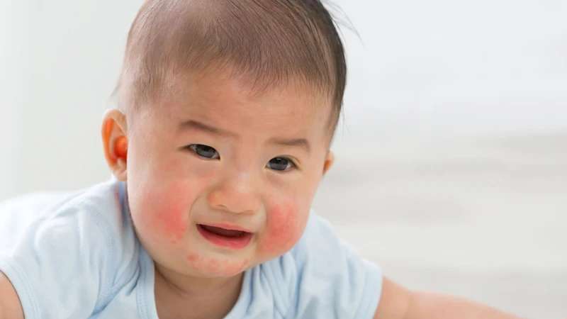 Bé bị nổi mẩn đỏ khắp người không sốt không ngứa có thể xuất phát từ nhiều nguyên nhân khác nhau nên cần theo dõi toàn diện thay vì chỉ nhìn vào nốt mẩn