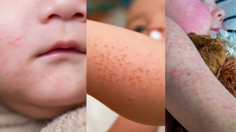 So sánh đặc điểm ban đỏ của một số bệnh thường gặp giúp cha mẹ dễ nhận biết sự khác biệt