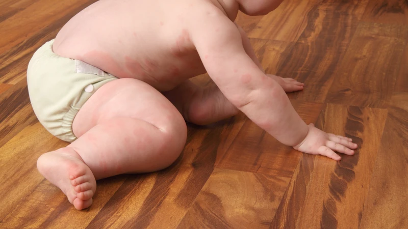 Ba mẹ cần chăm sóc da đúng cách, giữ cho da sạch sẽ, thoáng mát
