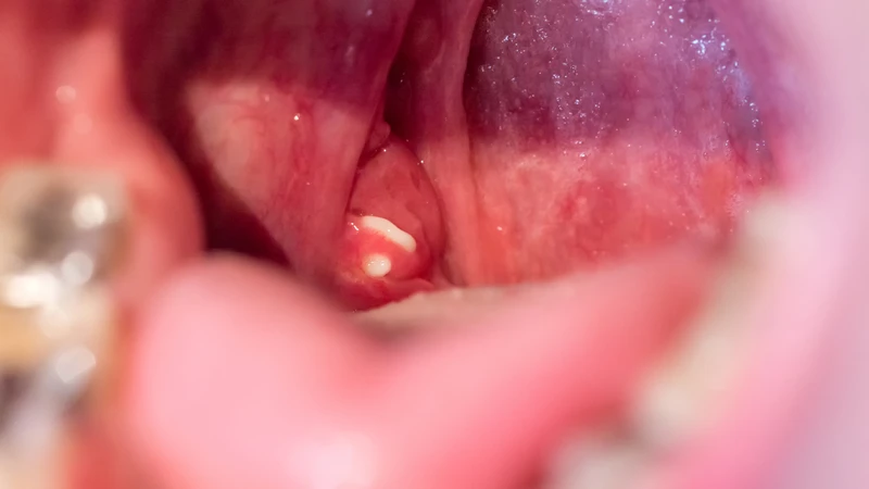 Bé bị viêm amidan bao lâu thì khỏi là thắc mắc của nhiều người
