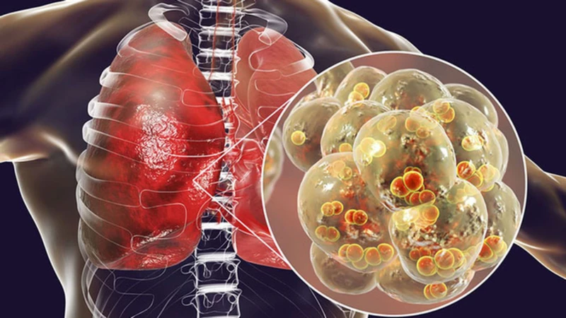 Bé bị viêm phổi tái đi tái lại: Nguyên nhân và cách phòng ngừa hiệu quả 2