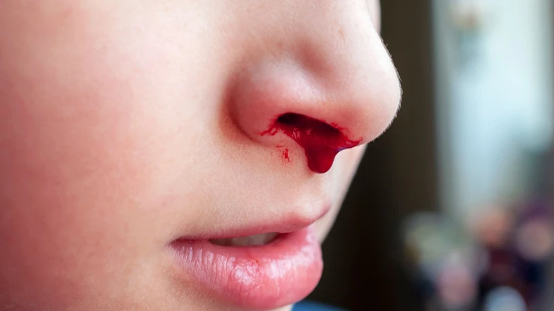 Một số nguyên nhân khiến trẻ bị chảy máu cam