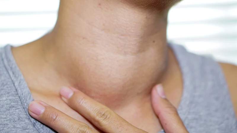 Bướu tuyến giáp có nguy hiểm không? Bệnh có thể gây các biến chứng nghiêm trọng