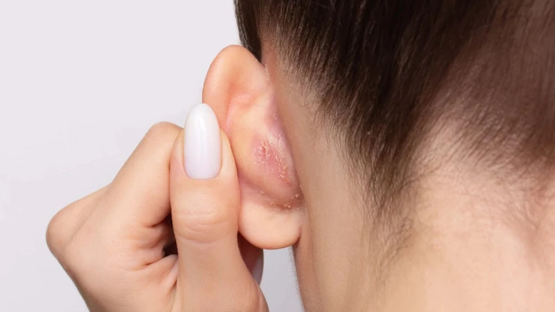 Chàm tai là một bệnh viêm da mạn tính xảy ra ở vùng vành tai hoặc ống tai ngoài