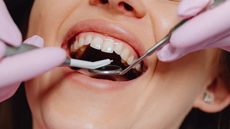 Thăm dò nha chu nhằm đánh giá rãnh nướu, mức độ chảy máu và sự bám dính của nướu quanh răng