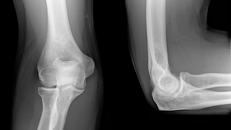 X-quang giúp phát hiện tổn thương xương, thoái hóa khớp hoặc vôi hóa gân