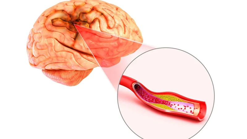 Mảng xơ vữa là một trong những nguyên nhân gây đột quỵ