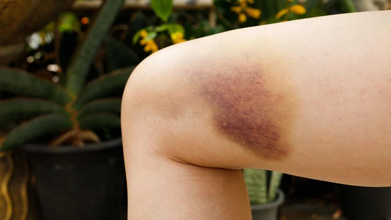Chỉ với va chạm nhẹ, người mắc bệnh Hemophilia cũng có thể xuất hiện các vết bầm lớn dưới da