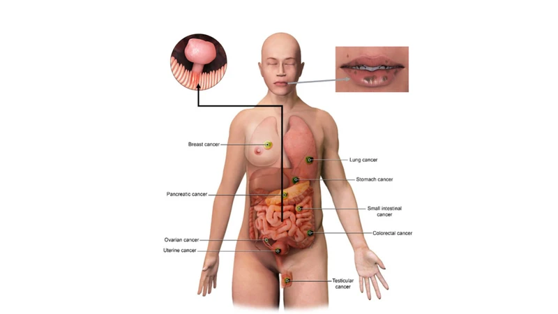 Người mắc hội chứng Peutz-Jeghers có nguy cơ ung thư đường tiêu hoá cũng như các ung thư khác cao hơn so với người bình thường