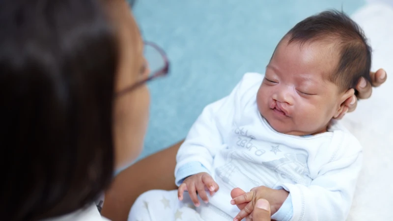 Trẻ mắc phải hội chứng DiGeorge có thể bị hở hàm ếch