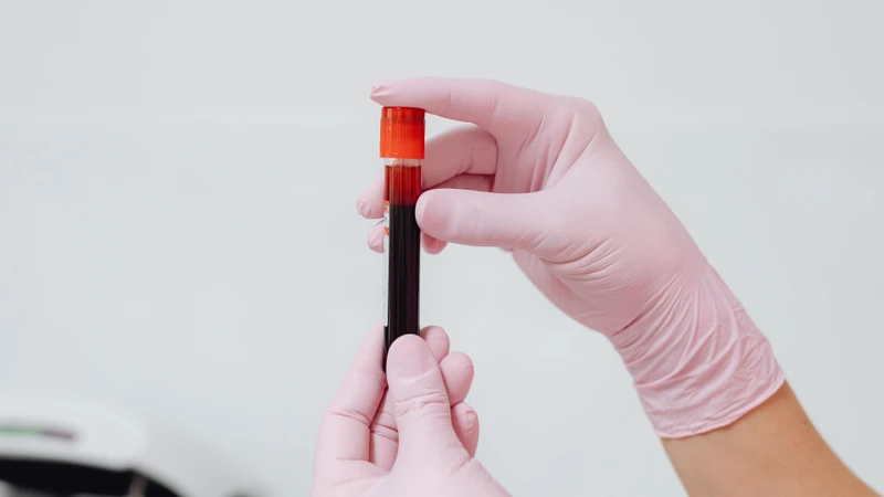 Xét nghiệm máu có thể được chỉ định để chẩn đoán hội chứng kháng phospholipid
