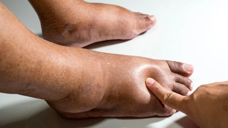Sưng phù chân trái là triệu chứng phổ biến nhất của hội chứng May Thurner