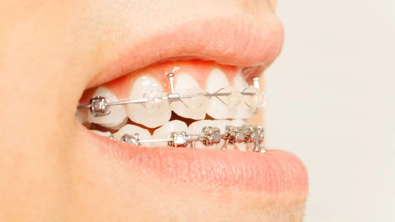 Niềng răng thường phù hợp khi khớp cắn ngược chủ yếu liên quan đến răng hoặc khi mức độ bất thường xương không quá lớn