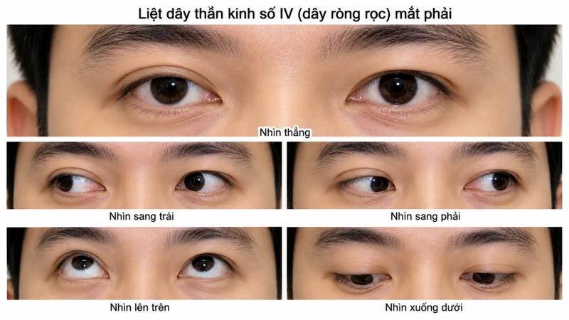 Liệt dây thần kinh số IV gây ra nhiều biểu hiện lâm sàng đặc trưng liên quan đến rối loạn vận động nhãn cầu và cơ chế bù trừ của người bệnh