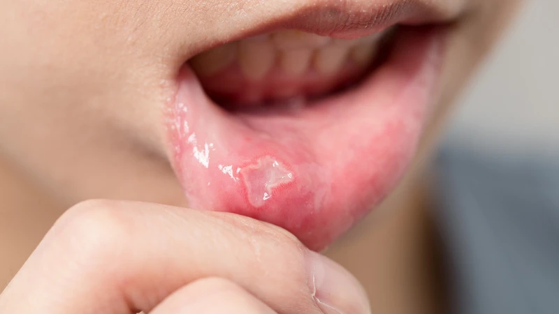 Loét miệng có đáy màu trắng ngà hoặc vàng nhạt, viền đỏ viêm xung quanh