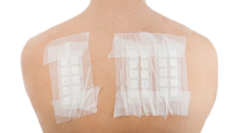 Khi nghi ngờ mề đay do dị nguyên, bác sĩ có thể chỉ định một số test chuyên biệt
