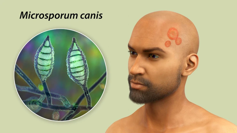 Microsporum là tác nhân gây nấm da thường gặp