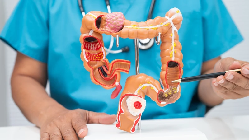 Polyp đại tràng sigma hình thành do sự tăng sinh bất thường của các tế bào niêm mạc đại tràng tại đoạn sigma