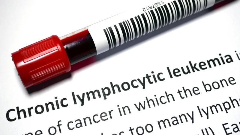 Bệnh bạch cầu lympho mạn tính có thể là nguyên nhân dẫn đến tan máu tự miễn